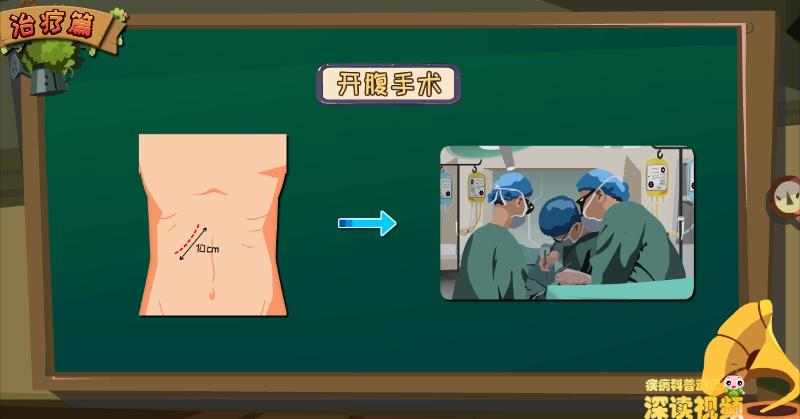 胆囊息肉还是胆囊癌？该如何确诊？动漫解密胆囊息肉检查那些坑