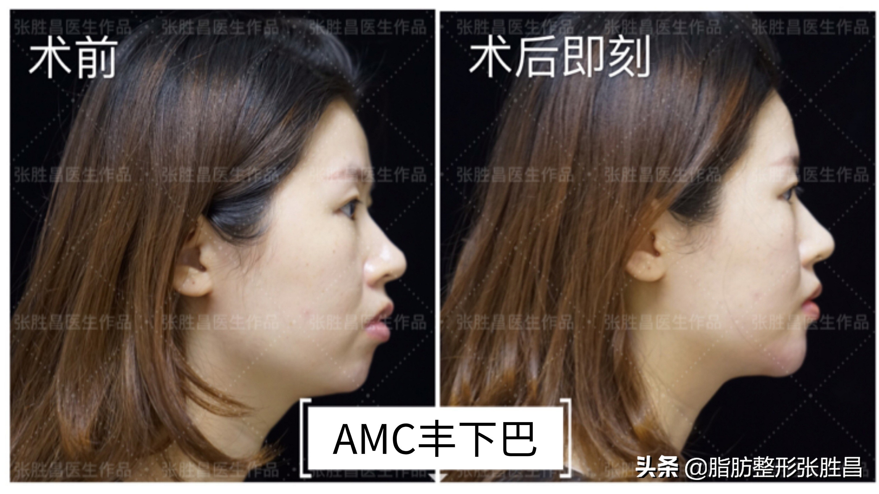 后缩的下巴打玻尿酸效果会好吗,下巴后缩打玻尿酸有效果吗