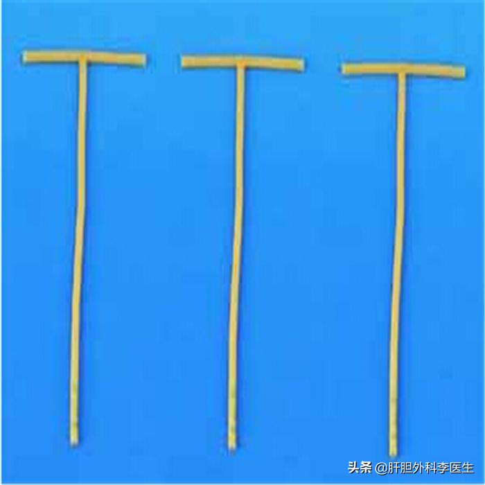 胆囊结石切除后胆管还会结石吗,胆囊结石合并胆息肉怎么办