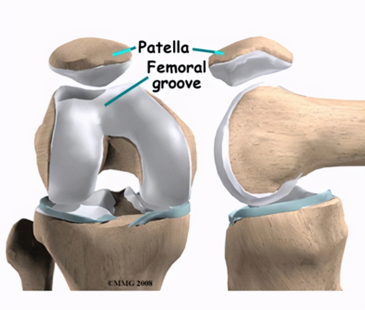 髌骨半脱位打石膏能彻底治愈吗,青少年膝盖半月板二级损伤