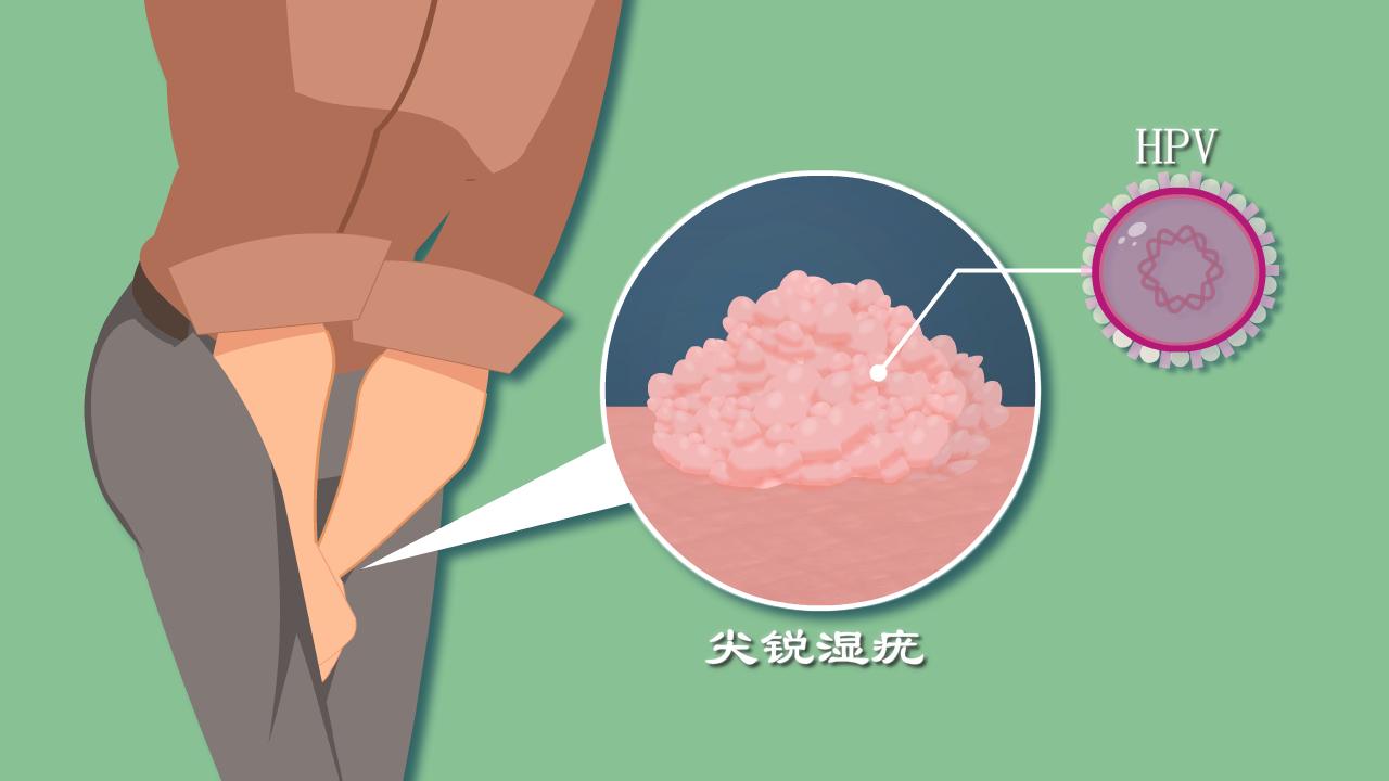 尖锐性湿疣都是hpv感染吗,尖锐性湿疣会引起hpv感染吗