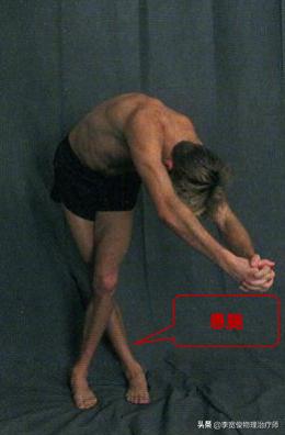 老生常谈跑步膝：髂胫束综合征（ITBS）