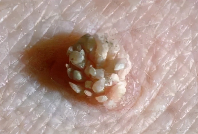 体表长肉疙瘩是病吗,私部有小肉瘤如何处理