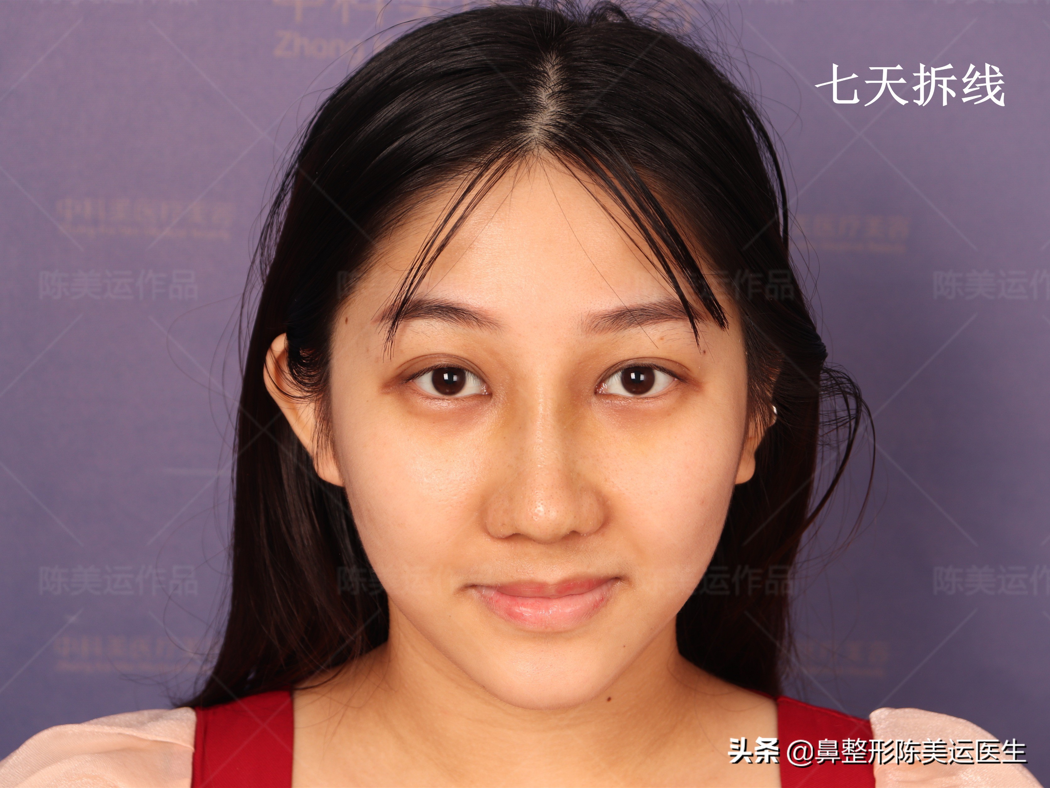 线雕隆鼻失败的图片,线雕隆鼻失败