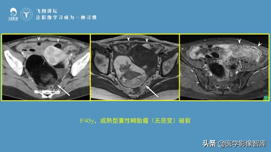 子宫解剖结构输卵管和卵巢位置,子宫附件ct影像学正常解剖表现
