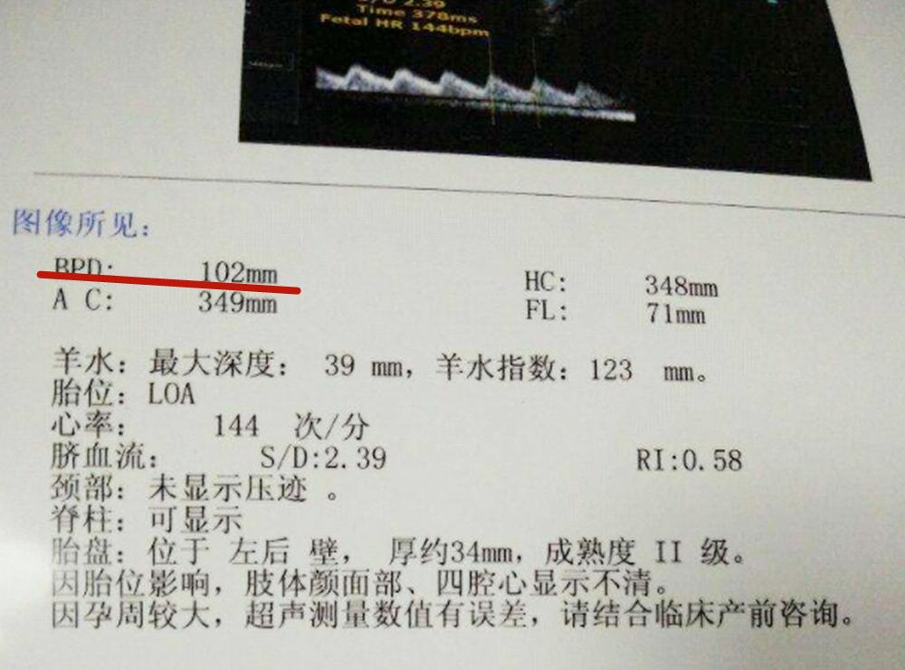 胎儿头大10厘米到底能不能顺产,胎儿双顶径9.4能自然分娩吗