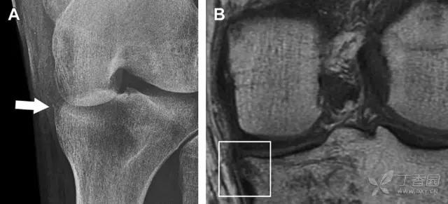 所有骨折都叫什么名字,骨折的名称有哪些