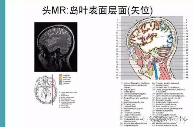 mra头颅解剖学详细讲解视频,常见的头颅mri图像