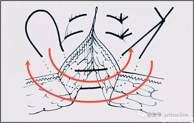 十种外科基本缝合方式详解,手术切口缝合有哪几种
