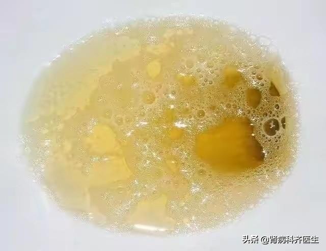 肾性血尿判断标准,血尿如何确认是肾炎还是结石