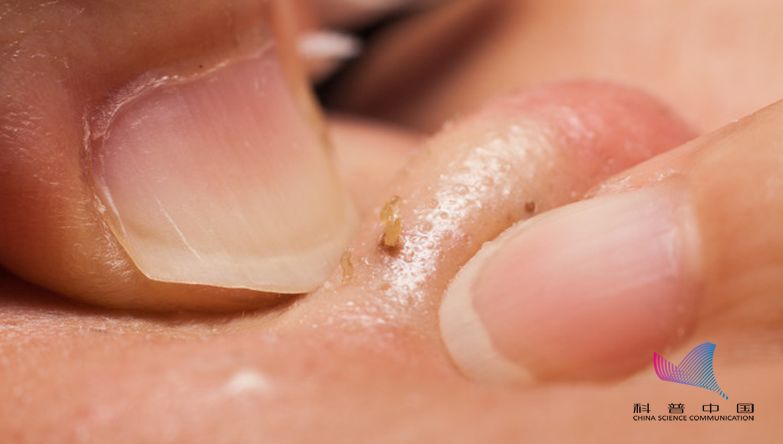 从鼻子里挤出来的白色物体是什么,鼻子上用力挤挤出来白色东西很臭