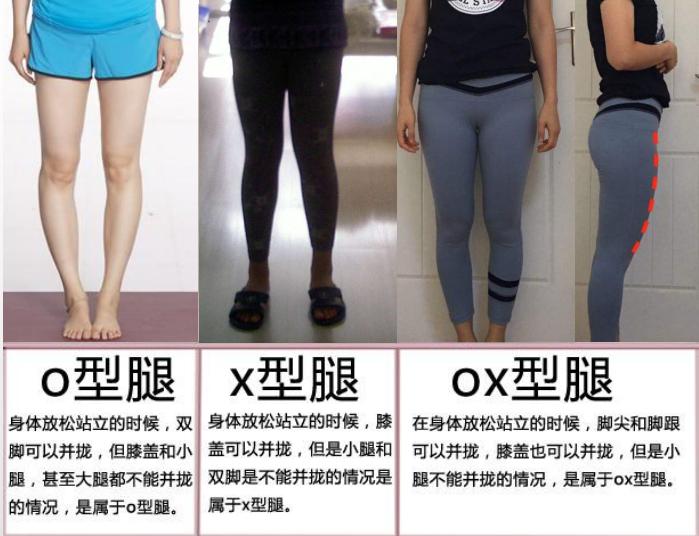 腿型管理腿不直改善各种不良腿型,腿部粗壮一般都会有腿型问题吗