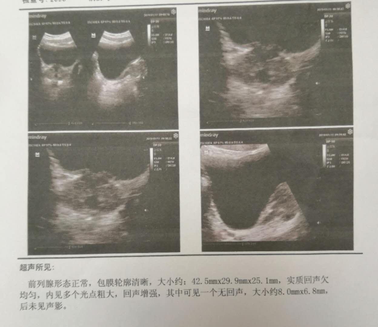 前列腺权威老中医,前列腺钙化中医疗法