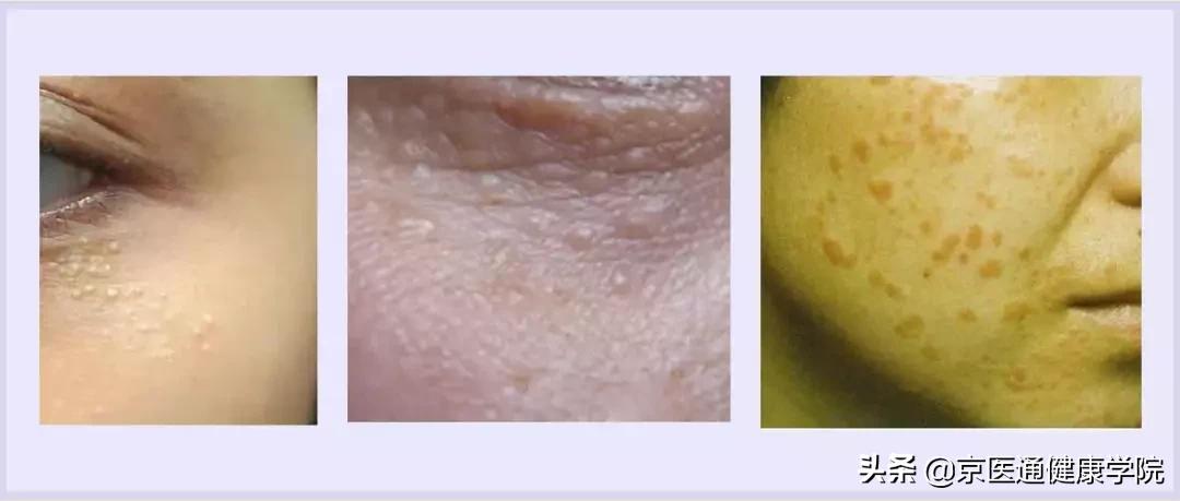 粟丘疹与汗管瘤脂肪粒去除小妙招,粟粒疹扁平疣