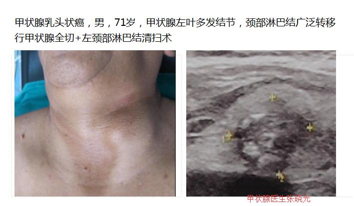 45岁女人声音嘶哑有什么病吗,46岁女突然嗓子哑了有痰吐出困难