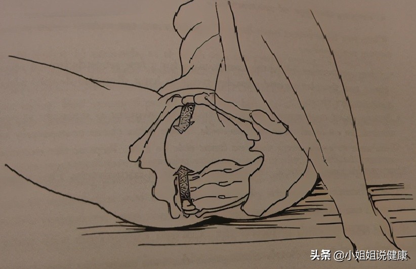 盆底锻炼除了凯格尔还有哪些,凯格尔运动能锻炼盆底深层肌肉吗