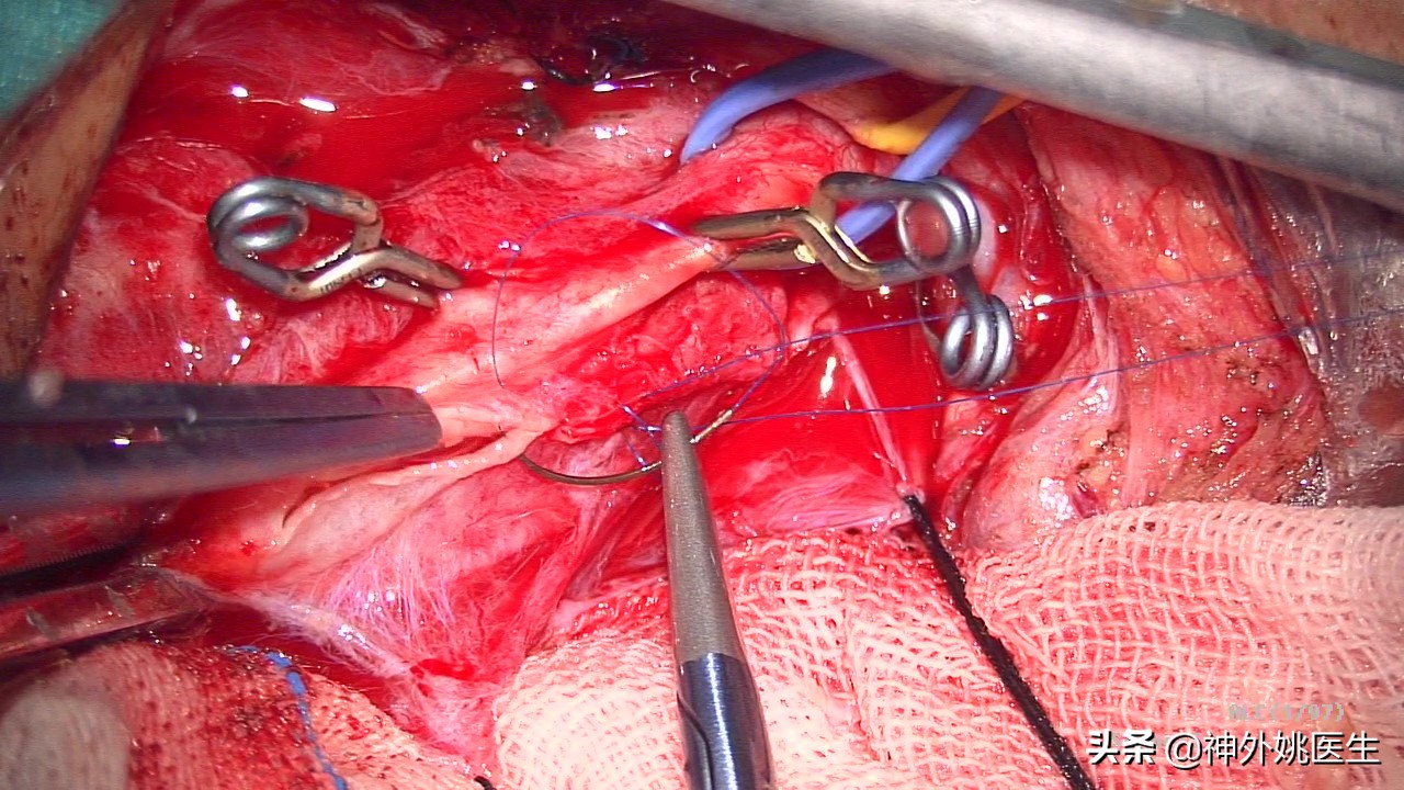 颈内动脉狭窄内膜剥脱术风险大吗,颈动脉内膜摘除手术