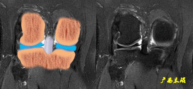 交叉韧带损伤的mr表现,后交叉韧带损伤的诊断实验