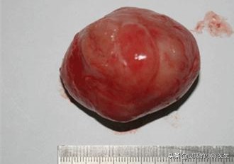 乳腺纤维瘤是实证还是虚证,乳腺纤维瘤是实性的还是囊性的