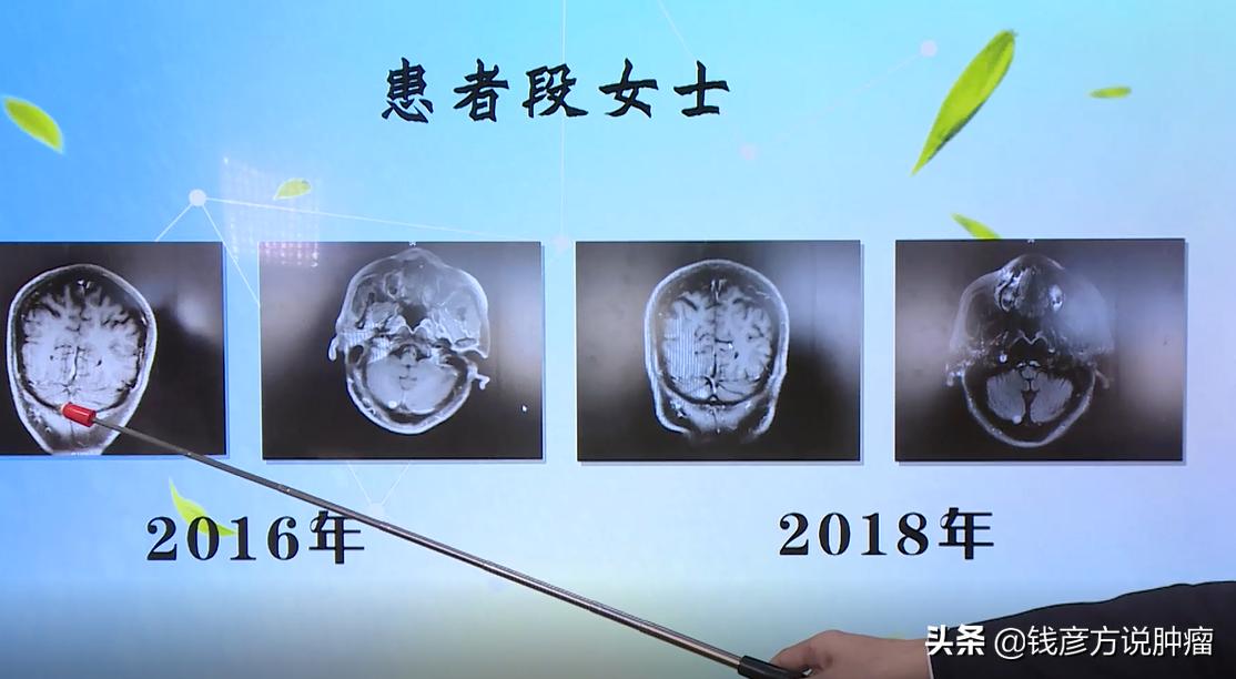 肺癌转移到脑部无对应靶向药,肺癌靶向治疗复查有结节