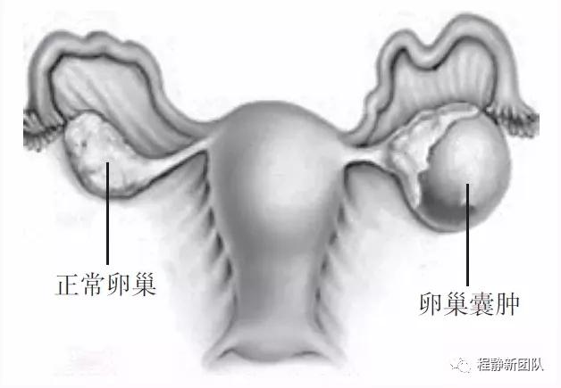 卵巢囊肿可怕吗？该如何处理？