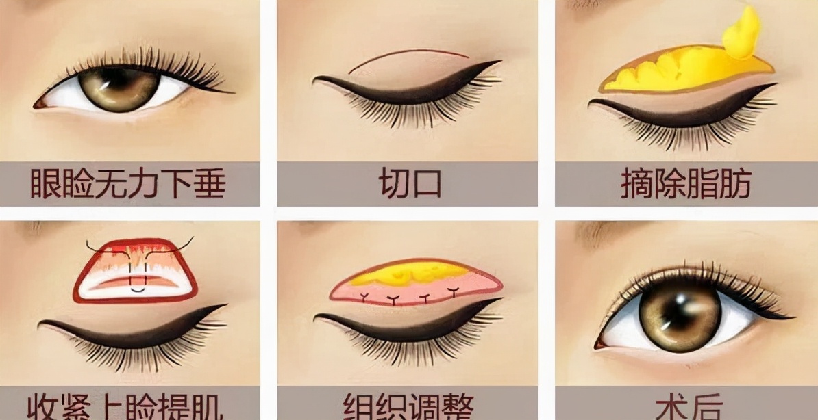 发现小孩大小眼越来越明显,小女孩大小眼怎么回事