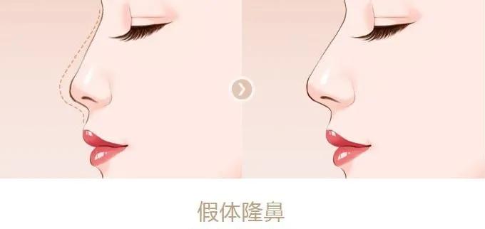 塌鼻梁怎么改善鼻托,塌鼻子可以恢复高鼻梁吗