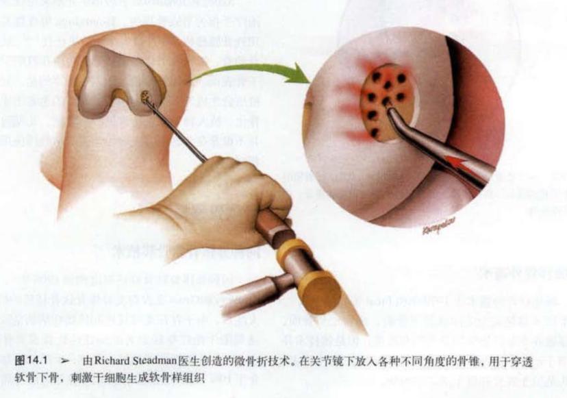 老年人骨性关节炎膝盖疼怎样锻炼,老年人膝关节骨关节炎首选检查