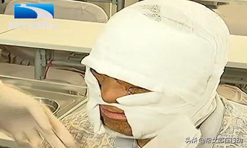 小伙被烧伤,小伙为救人烧伤毁容最后结果