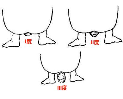 脱肛和痔疮脱出有什么区别,肛门坠胀有肉球脱出是痔疮吗