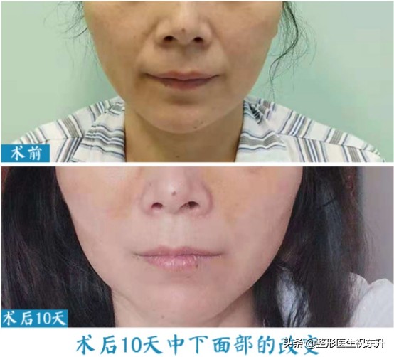 眼袋越来越重是身体哪里出问题了,为什么你会有眼袋