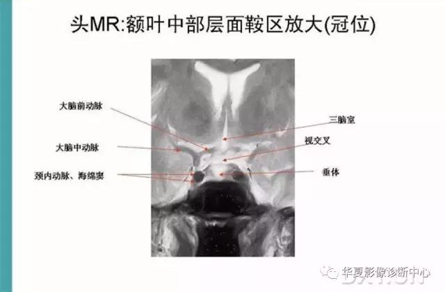 mra头颅解剖学详细讲解视频,常见的头颅mri图像