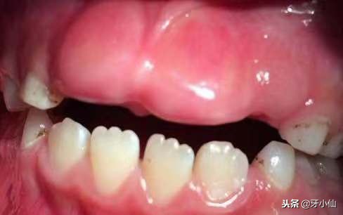 小孩牙长不出来割一下需要多少钱,儿童畸形牙拔了不长怎么办