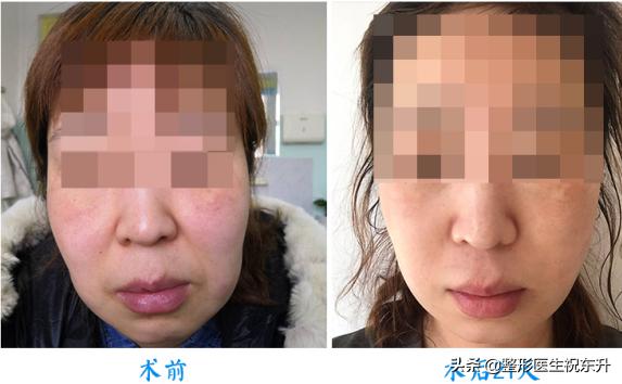 双下巴、脖子粗，又丑又显老，如何减掉双下巴？