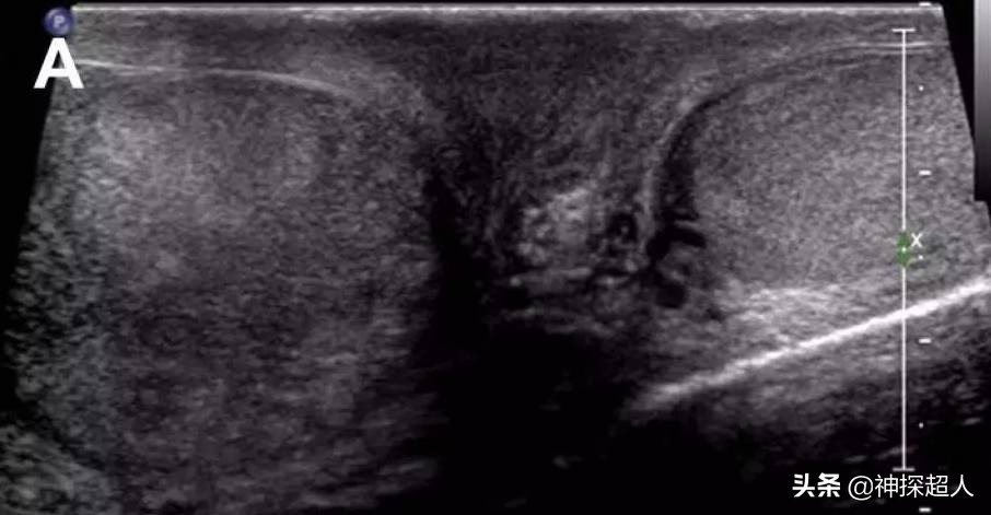 男性“蛋蛋”痛，必须引起重视，特别是一侧突发痛