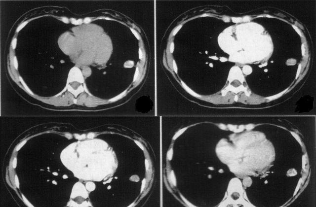 花甲老人身患“肺结核”多年，身体却很康健，是什么原因