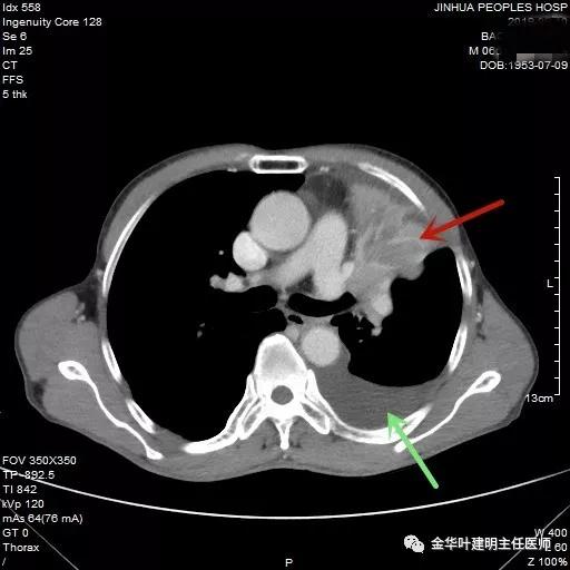 肺癌伴胸腔积液伴膨胀不全,肺癌晚期转移到肝脏引起腹腔积液
