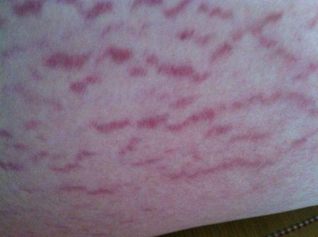 有肥胖纹的人可以消减肥胖纹吗,祛除肥胖纹最有效的方法