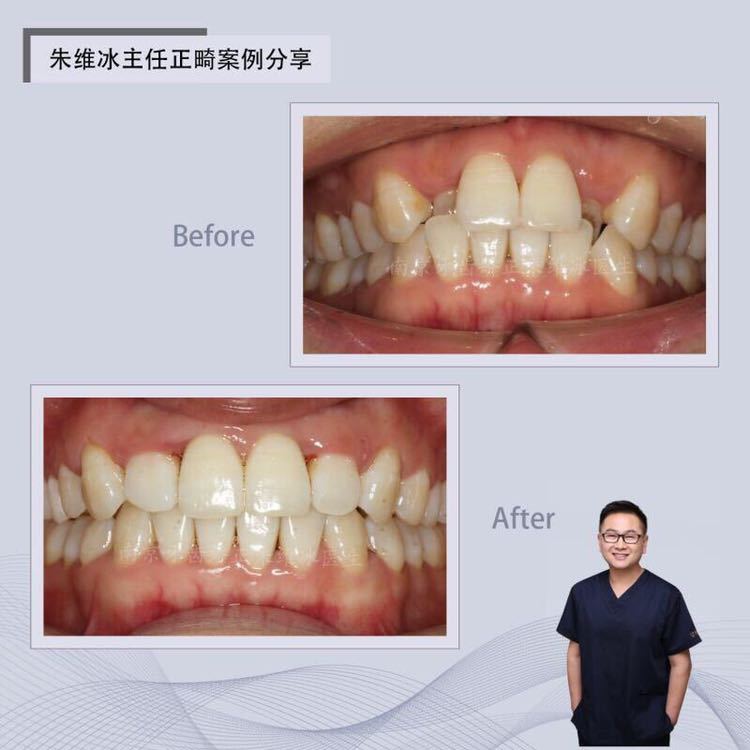 南京正畸朱维冰怎么样,南京牙齿正畸矫正技术