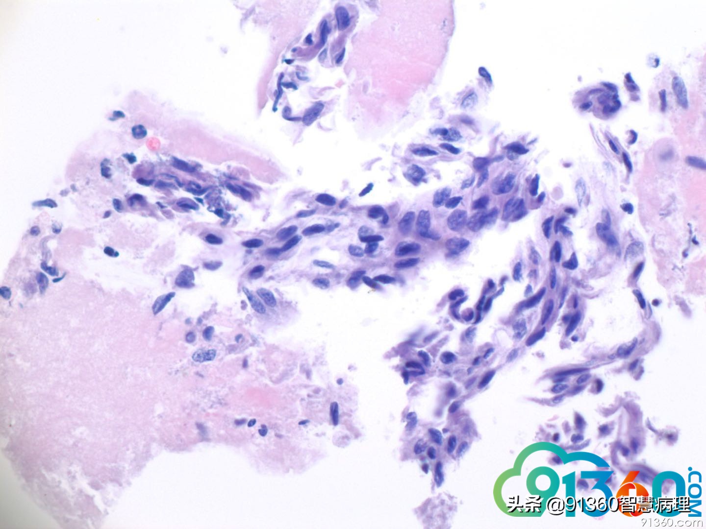 宫颈病理tct是什么检查,tct出现ascus会是宫颈癌吗