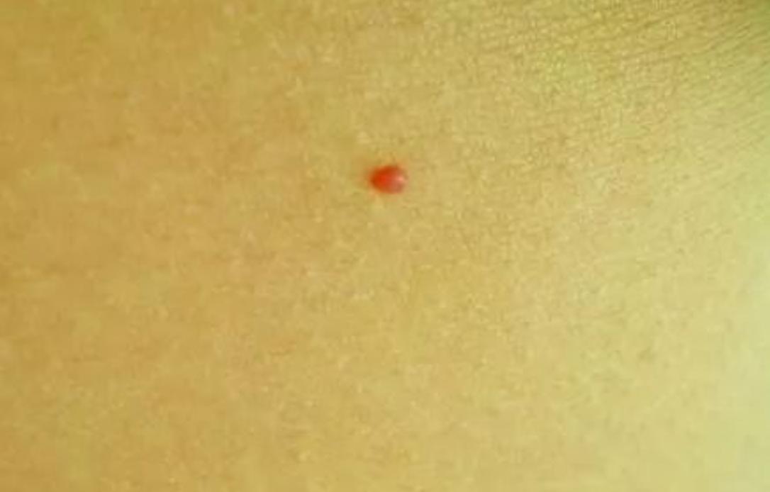 身上的痣自己会消除吗,身上的痣能随便去掉会死吗