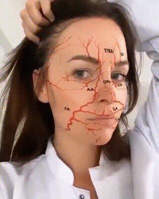 玻尿酸导致血管栓塞图,警惕注射过程中的风险