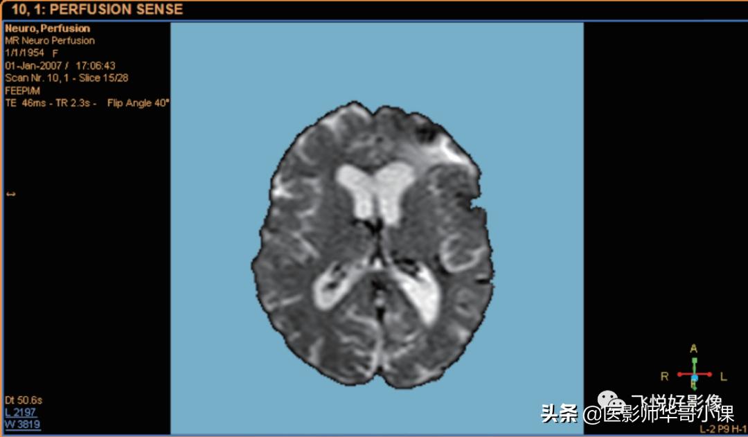 飞利浦磁共振脑灌注怎么测量,飞利浦核磁诊断教学