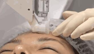 靠“副作用”上位的美白新贵——氨甲环酸到底有多神奇