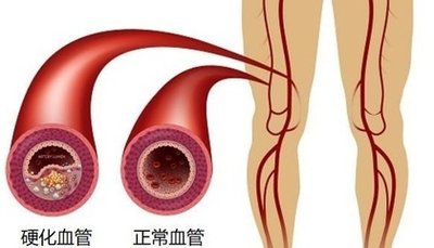 鱼油和卵磷脂可以代替他汀吗,鱼油能代替阿托伐他汀