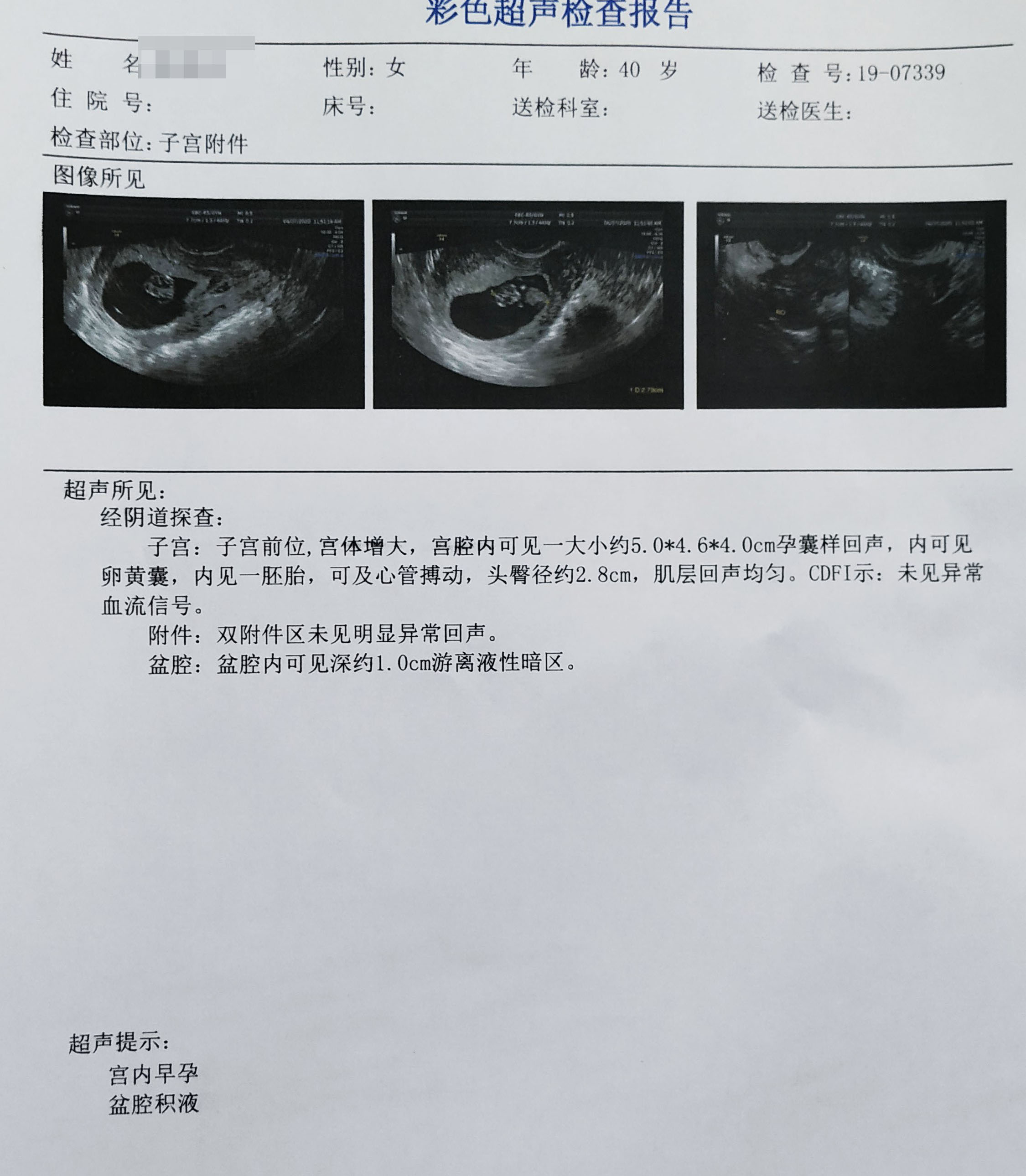 结扎后复通要多久才能怀孕,结扎后复通多久才可以怀孕