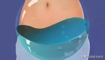 肿瘤盆腔积液和腹部积液,良性卵巢肿瘤伴有盆腔积液