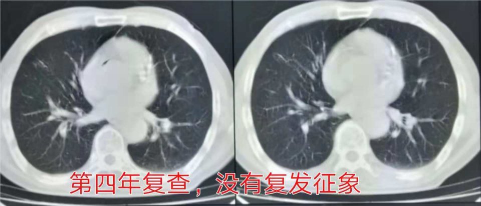 与肺癌病人一起生活需要关注什么,与肺癌抗战的第七个月