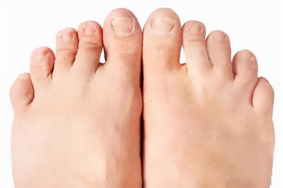 脚背痛风与大拇指痛风,痛风都什么症状关节会肿吗