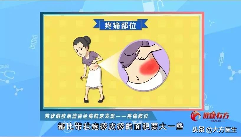 带状疱疹疼痛及后遗神经痛的治疗,带状疱疹后遗神经痛治疗后还痛